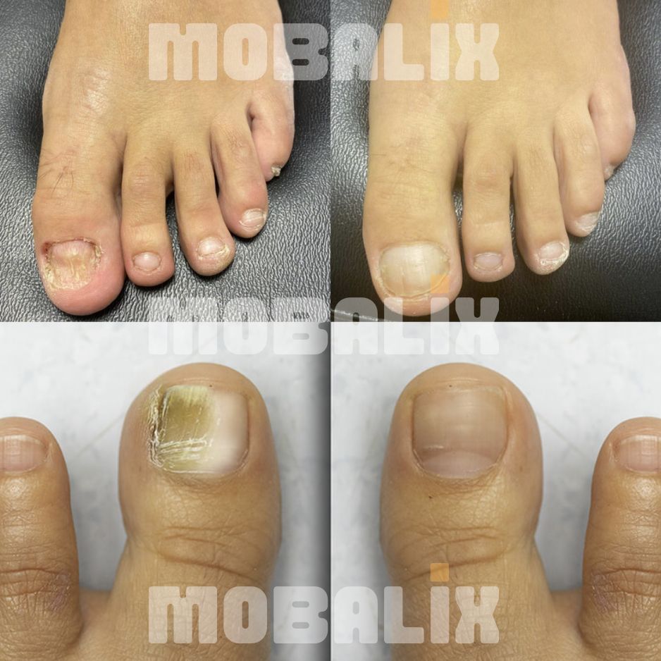 MycoTens™ – Bild 3